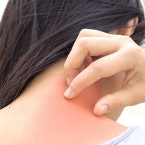 Heat rash: How to spot it and what to do